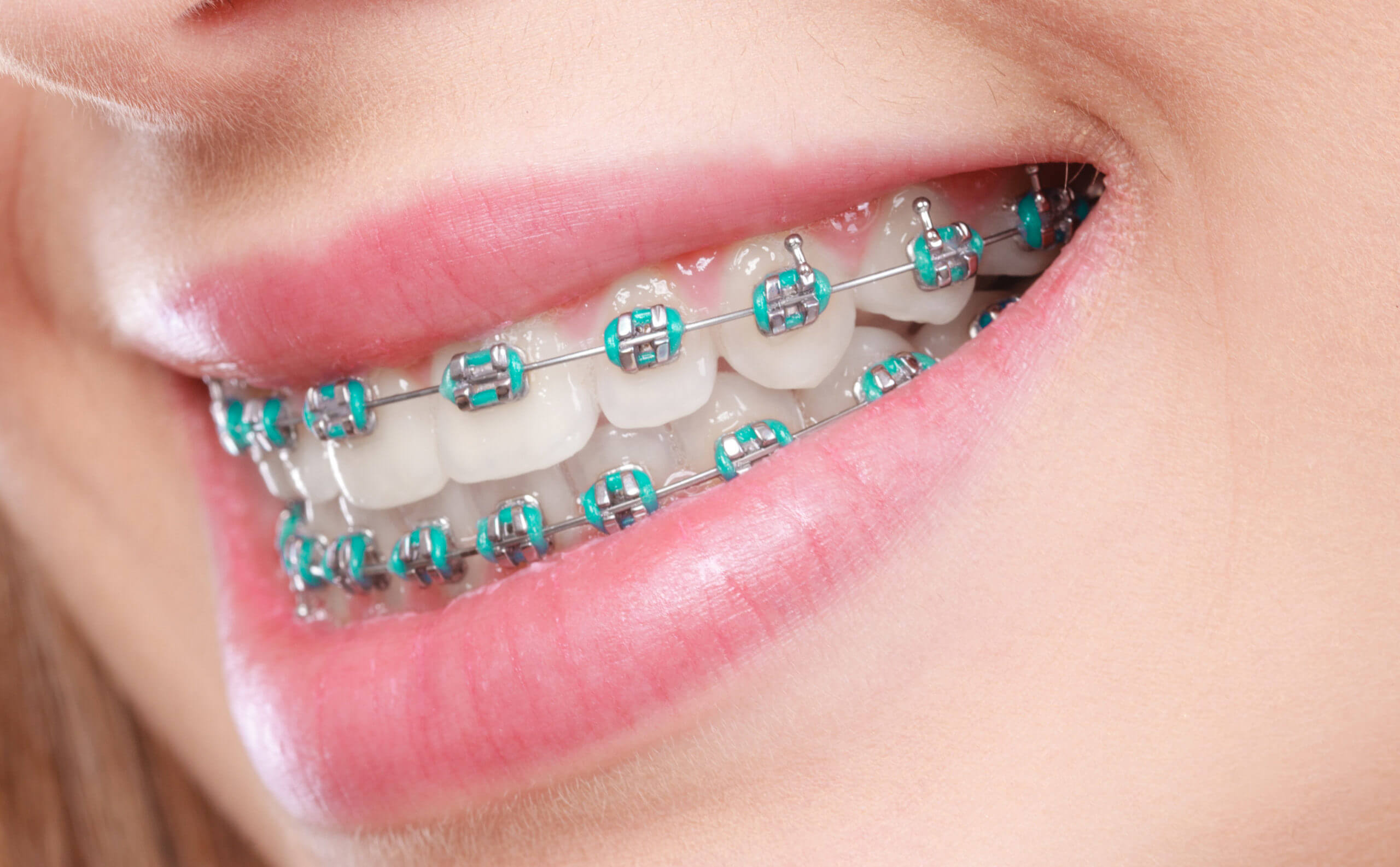Dental Braces